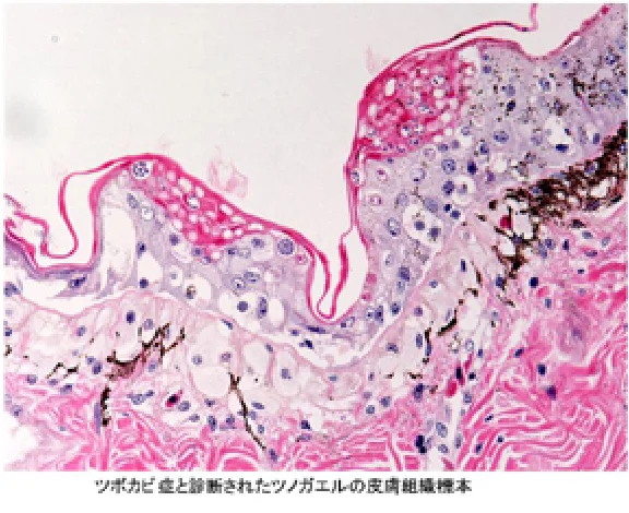ツボカビ症のツノガエルの皮膚組織標本